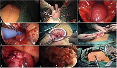 Preliminary Analysis of Safety and Feasibility of a Single-Hole Laparoscopic Myomectomy via an Abdominal Scar Approach